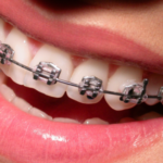 Ortodoncja w dojrzałym wieku – czy to wstyd?